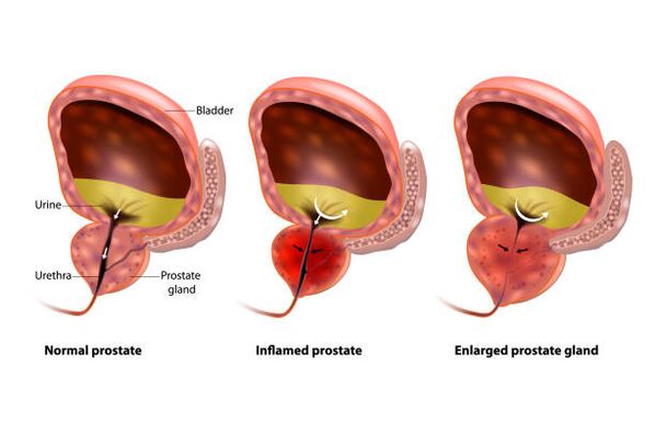 Prostatitis is inflammation of the prostate