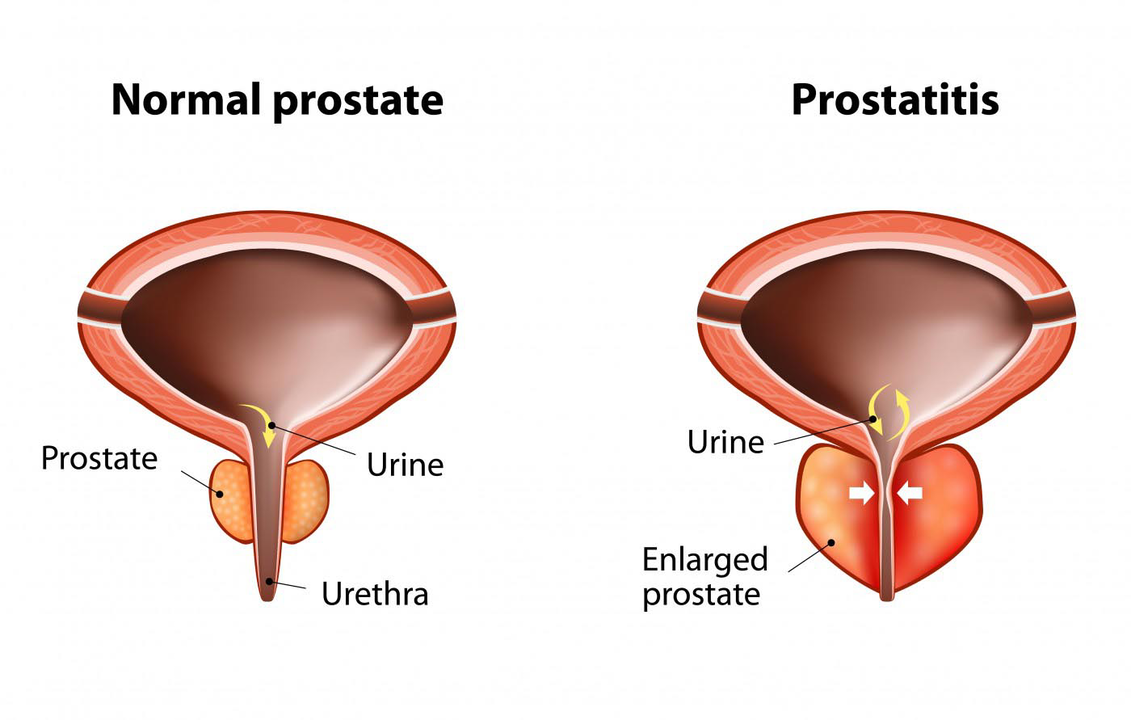 Normal prostate in healthy men and prostate inflammation in patients with prostatitis